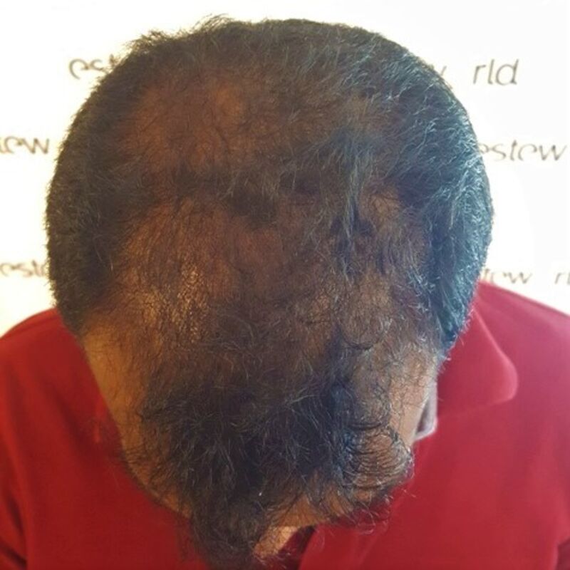 Kasan, 1/3de van kosten haartransplantatie in Nederland