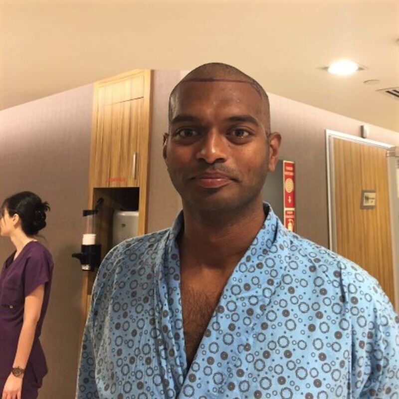 Kasan, 1/3de van kosten haartransplantatie in Nederland