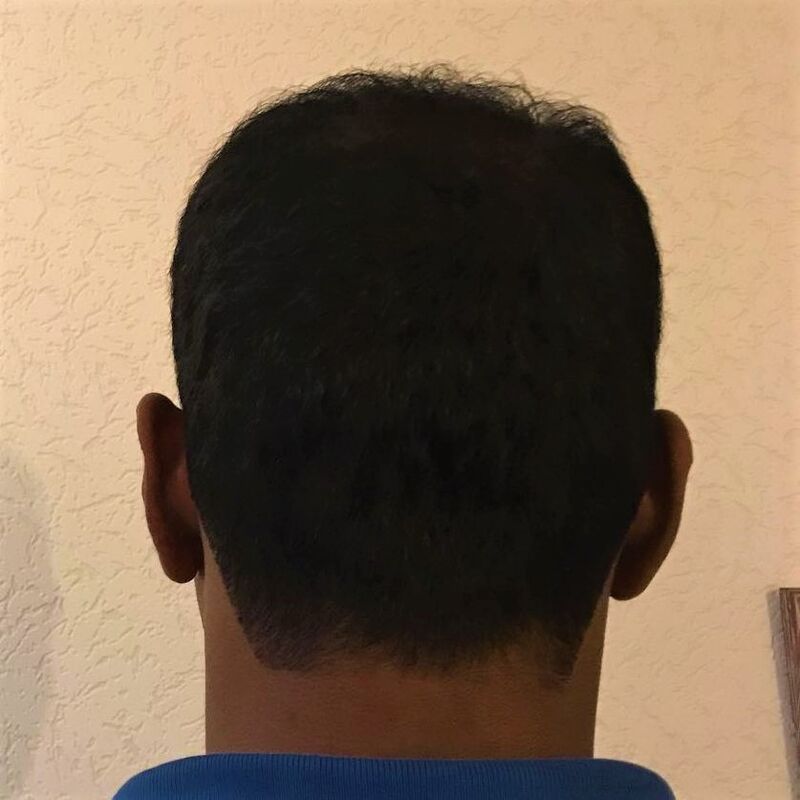 Kasan, 1/3de van kosten haartransplantatie in Nederland