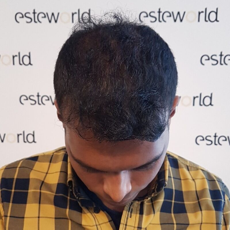 Kasan, 1/3de van kosten haartransplantatie in Nederland