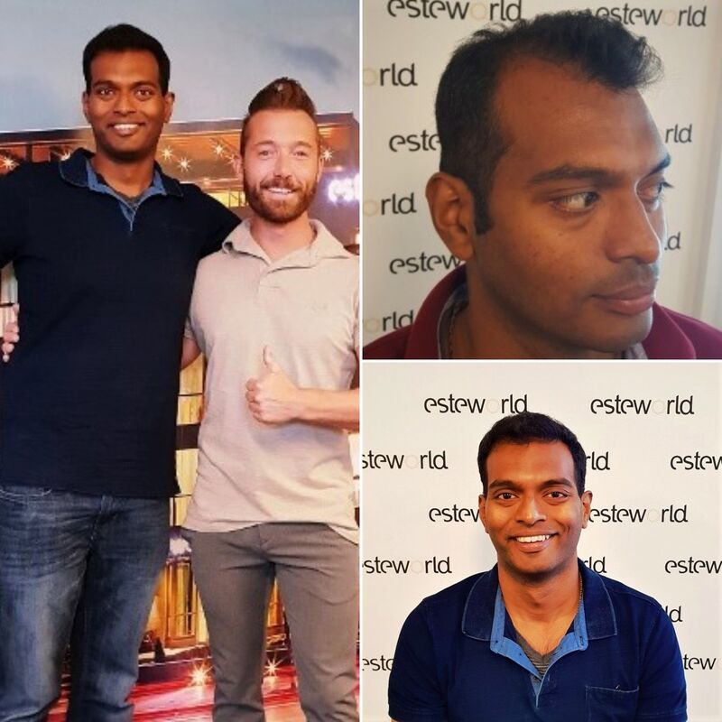 Kasan, 1/3de van kosten haartransplantatie in Nederland