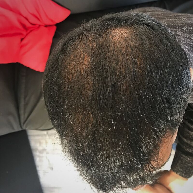Kasan, 1/3de van kosten haartransplantatie in Nederland