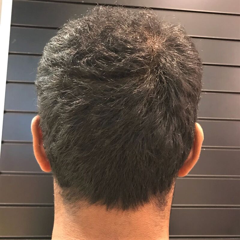 Kasan, 1/3de van kosten haartransplantatie in Nederland