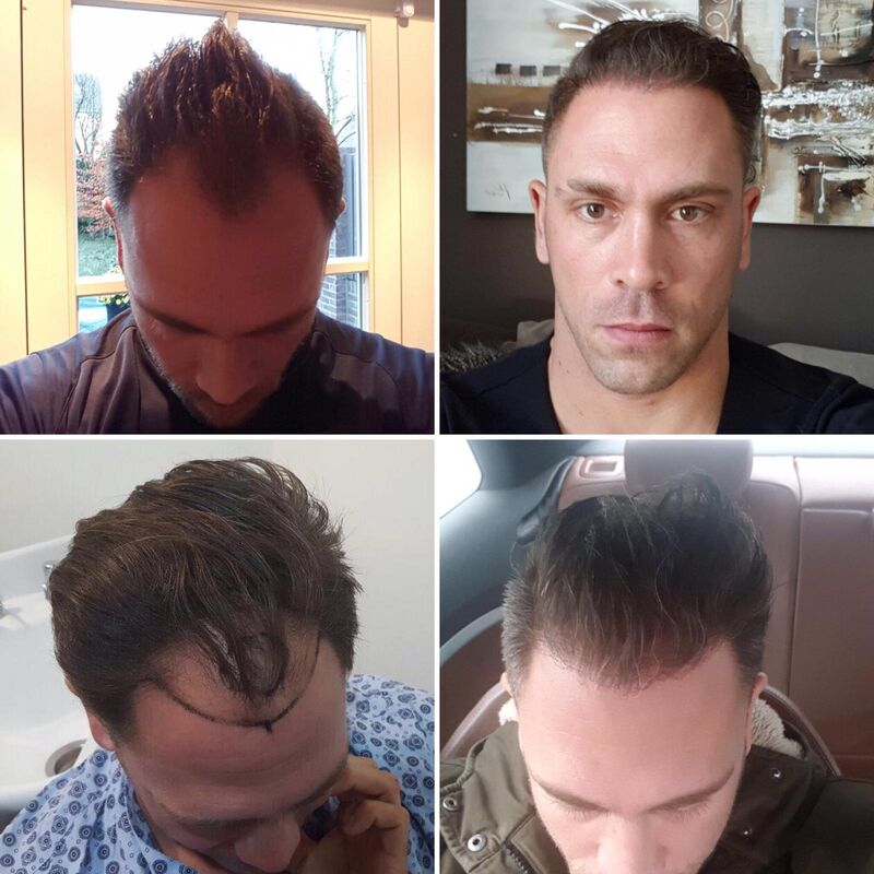 Eric, De hele haartransplantatie is perfect verlopen!