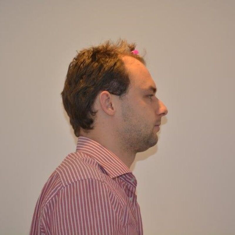 Manuel blij met zijn haartransplantatie resultaat!