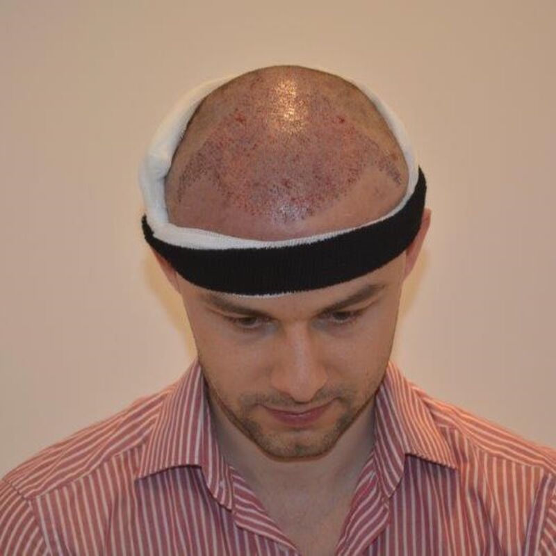 Manuel blij met zijn haartransplantatie resultaat!