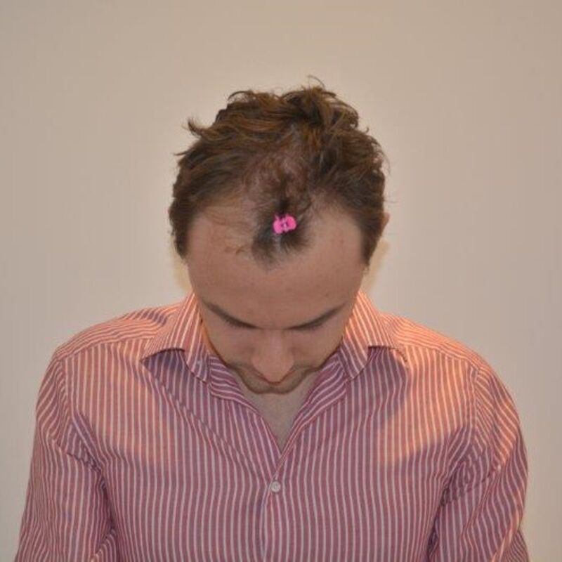 Manuel blij met zijn haartransplantatie resultaat!