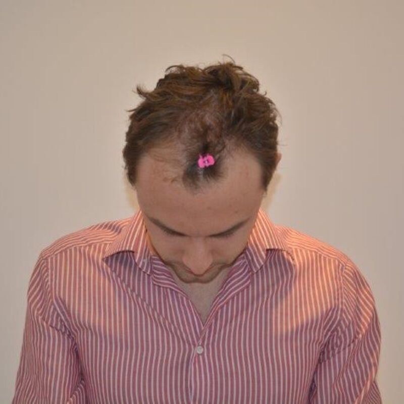 Manuel blij met zijn haartransplantatie resultaat!