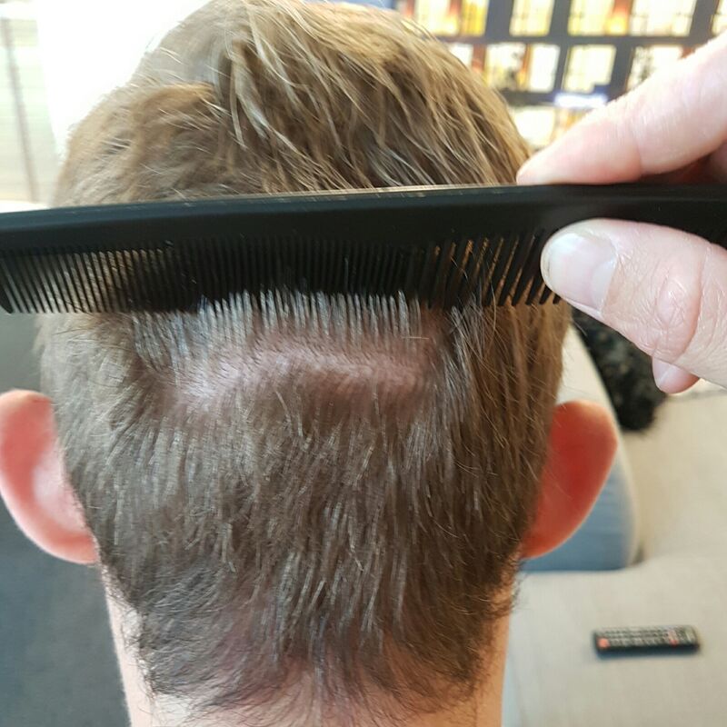 Manuel blij met zijn haartransplantatie resultaat!