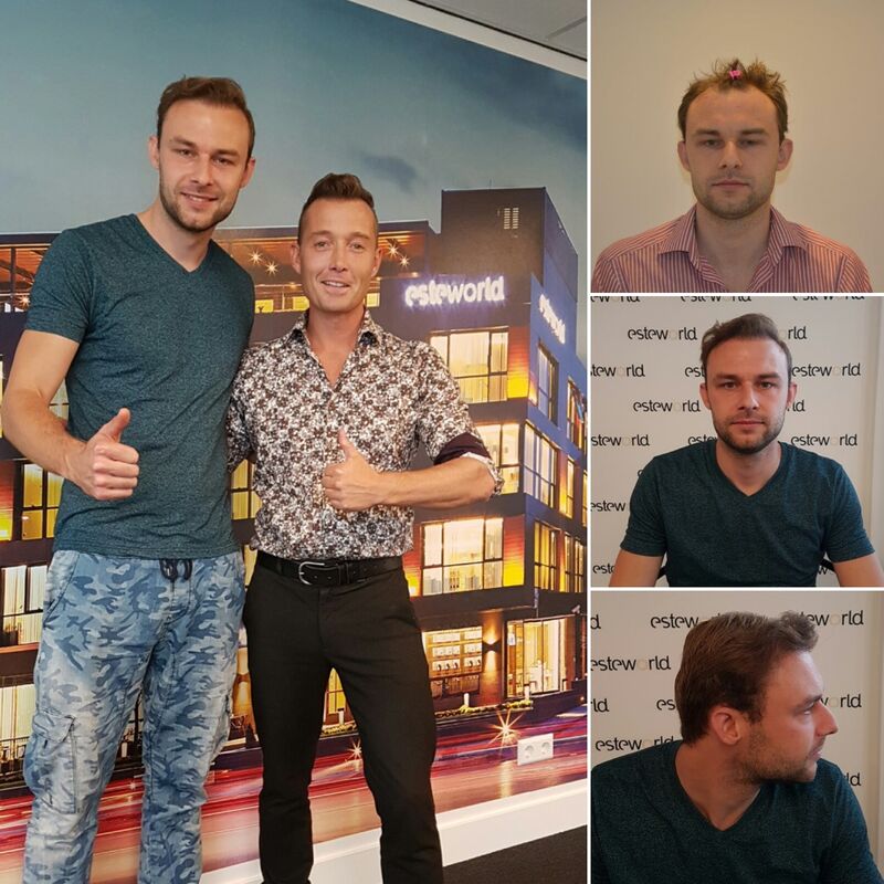 Manuel blij met zijn haartransplantatie resultaat!
