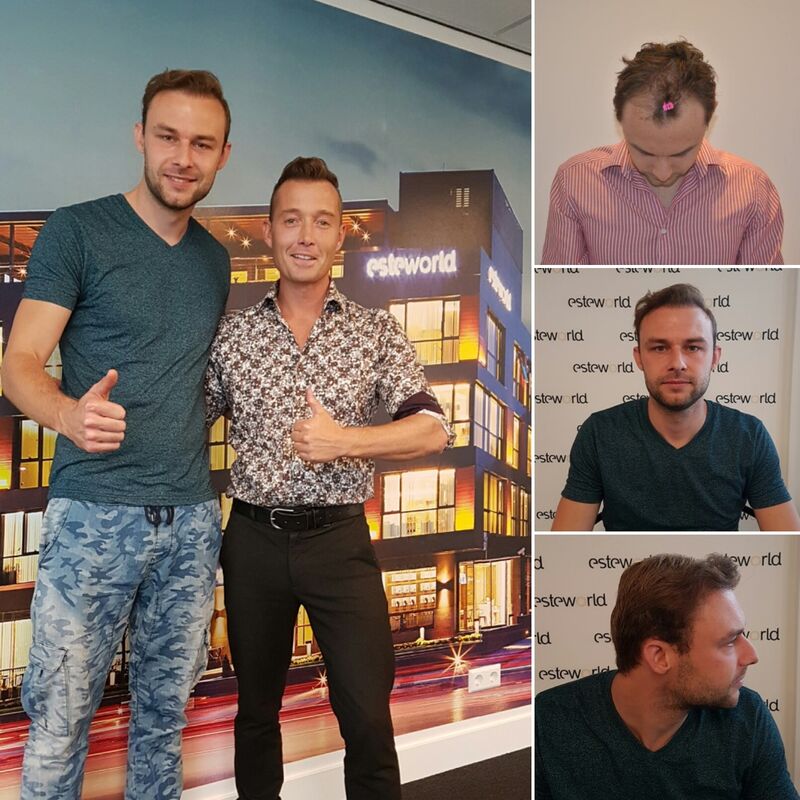Manuel blij met zijn haartransplantatie resultaat!