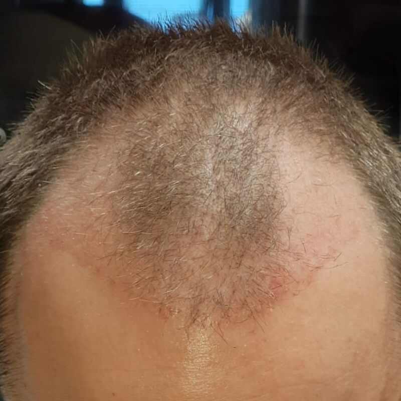 Wat doe je als je haar langzaam verdwijnt? Esteworld! 