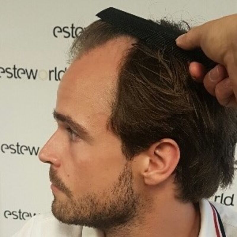 Wat doe je als je haar langzaam verdwijnt? Esteworld! 