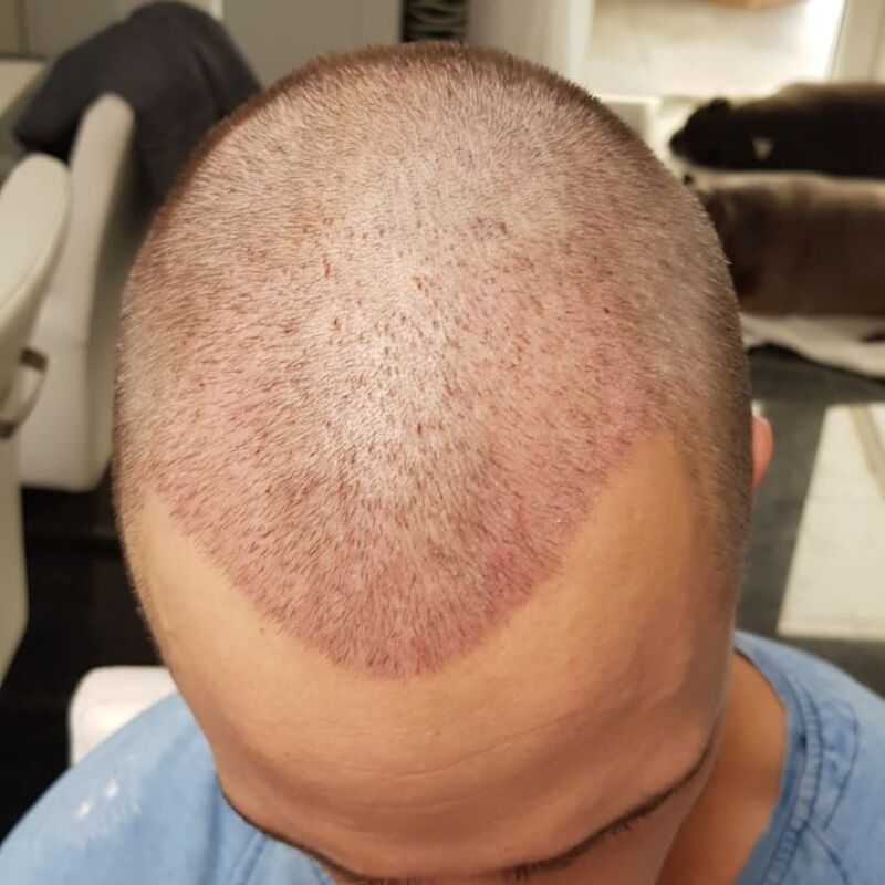 Wat doe je als je haar langzaam verdwijnt? Esteworld! 