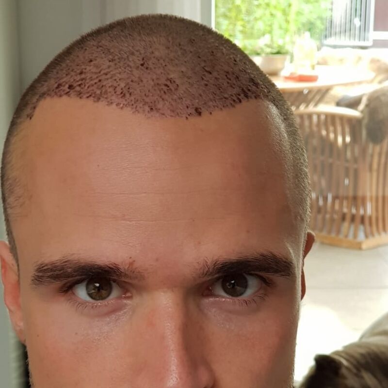 Wat doe je als je haar langzaam verdwijnt? Esteworld! 