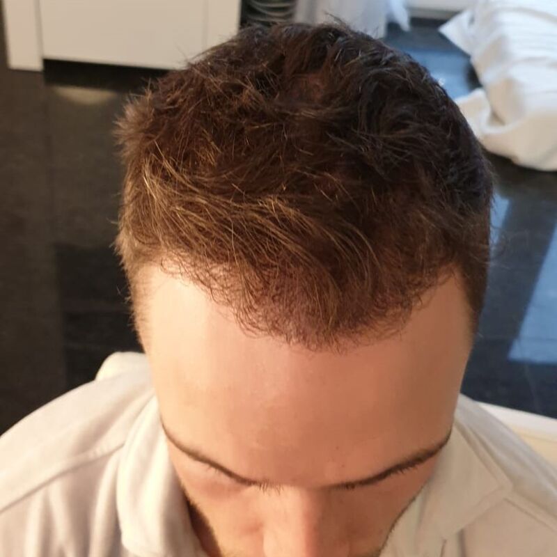 Als je haar langzaam verdwijnt? Haartransplantatie bij Esteworld! 