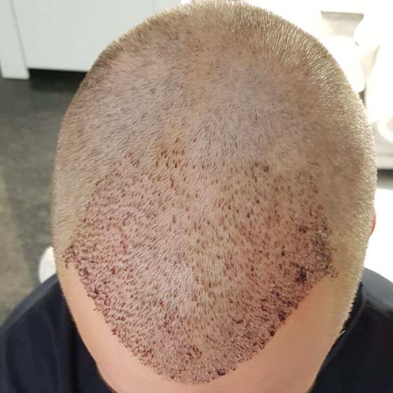 Als je haar langzaam verdwijnt? Haartransplantatie bij Esteworld! 