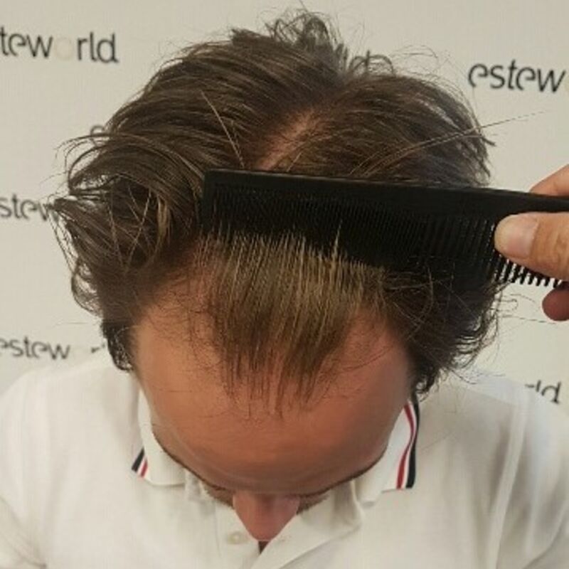 Wat doe je als je haar langzaam verdwijnt? Esteworld! 