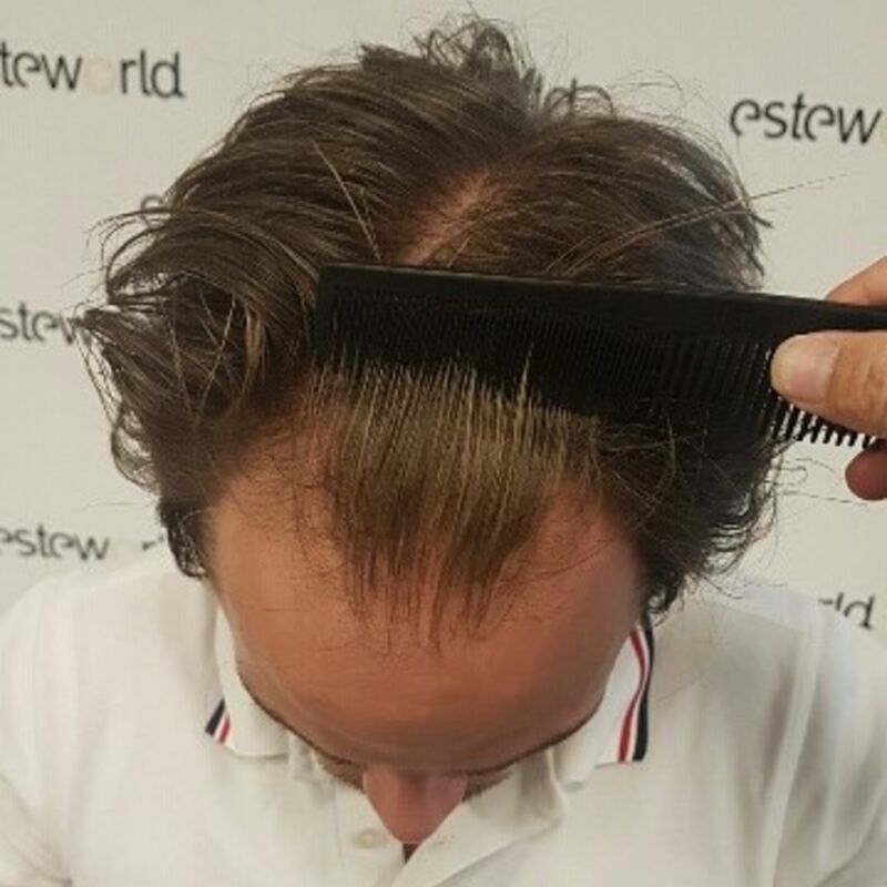 Als je haar langzaam verdwijnt? Haartransplantatie bij Esteworld! 