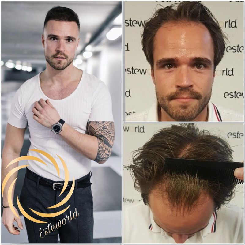 Als je haar langzaam verdwijnt? Haartransplantatie bij Esteworld! 