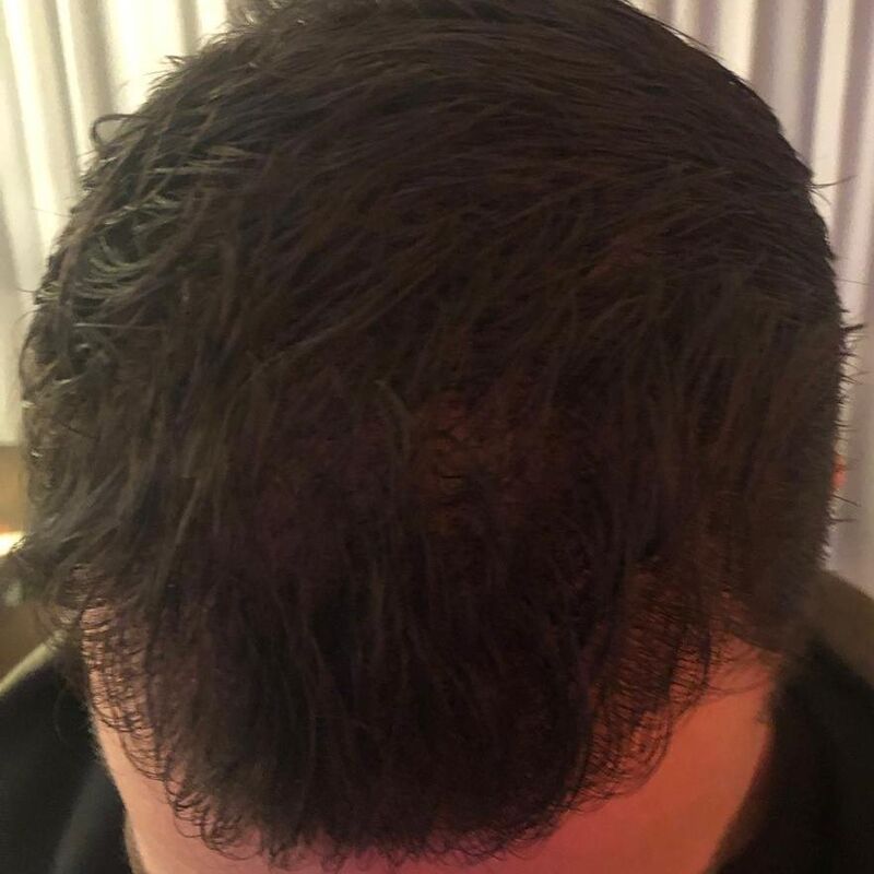 10+ voor de haartransplantatie in Turkije!