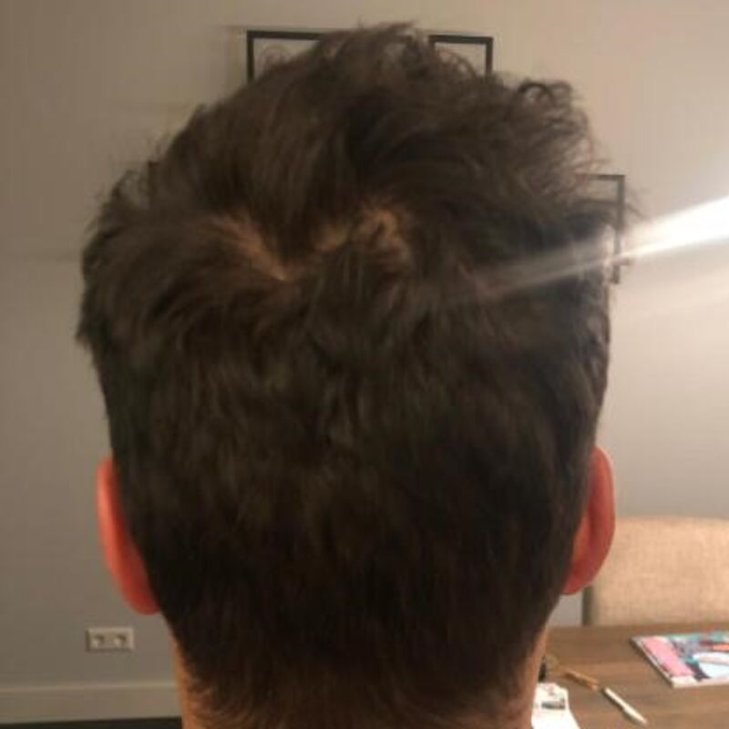 10+ voor de haartransplantatie in Turkije!