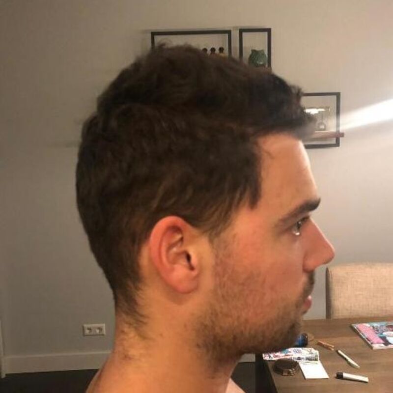10+ voor de haartransplantatie in Turkije!