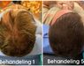 XL Hair Mesotherapie