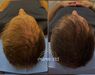 XL Hair Mesotherapie