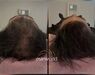 XL Hair Mesotherapie