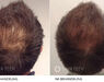 Mesotherapie behandeling ervaringen