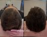 Low Level Laser Therapie (LLLT)