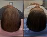 Low Level Laser Therapie (LLLT)