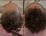 Low Level Laser Therapie (LLLT)