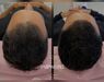 Low Level Laser Therapie (LLLT)