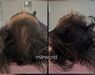 Low Level Laser Therapie (LLLT)