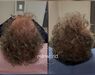 Low Level Laser Therapie (LLLT)