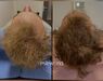 Low Level Laser Therapie (LLLT)