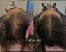 Low Level Laser Therapie (LLLT)