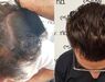 Acell stamcel behandeling