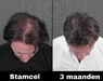 Acell stamcel behandeling