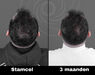 Acell stamcel behandeling