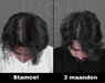 Acell stamcel behandeling