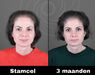 Acell stamcel behandeling