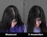 Acell stamcel behandeling