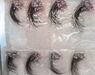 Lang haar Haartransplantatie