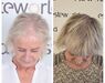 Haartransplantaties zonder scheren en de Long Hair methode