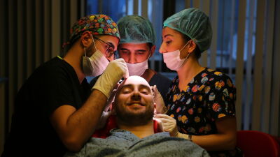 Haartransplantatie klinieken vergelijken in Turkije