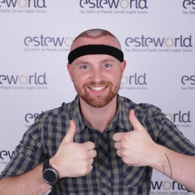 Waar vind ik de beste haartransplantatie kliniek?