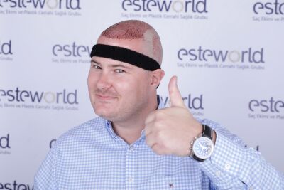 Haartransplantatie Turkije. Waarom?